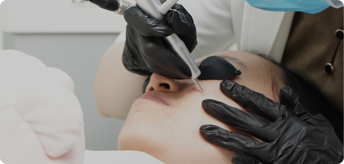 Trị sẹo - lỗ chân lông