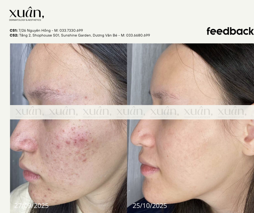 hiệu quả khách hàng điều trị mụn