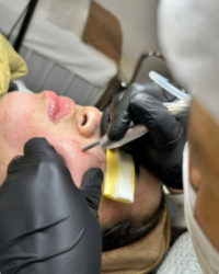 Skin Rejuvenation & Resurfacing