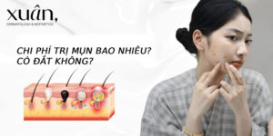 chi phí trị mụn