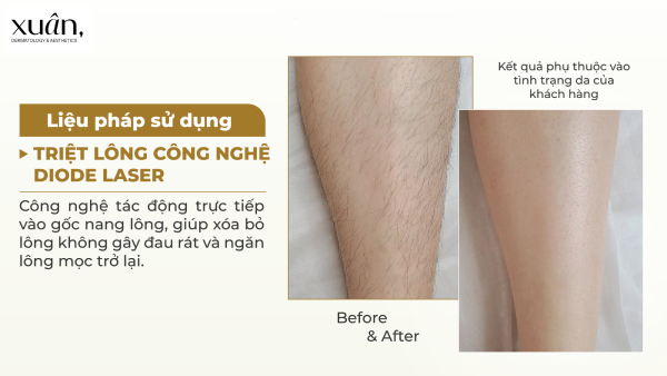 hiệu quả triệt lông tại Xuân clinic
