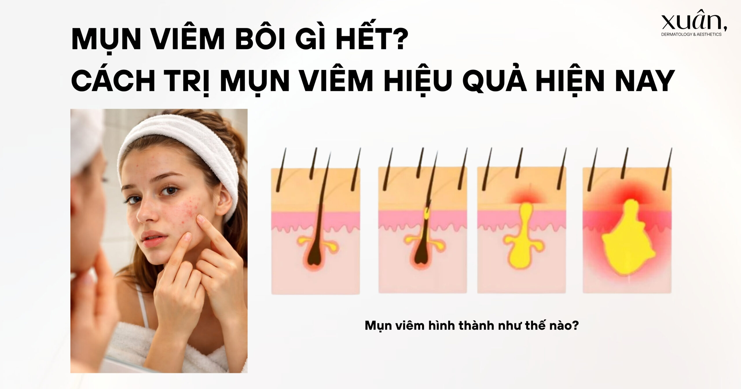 Mụn Viêm Bôi Gì Hết? Cách Trị Mụn Viêm Hiệu Quả Hiện Nay
