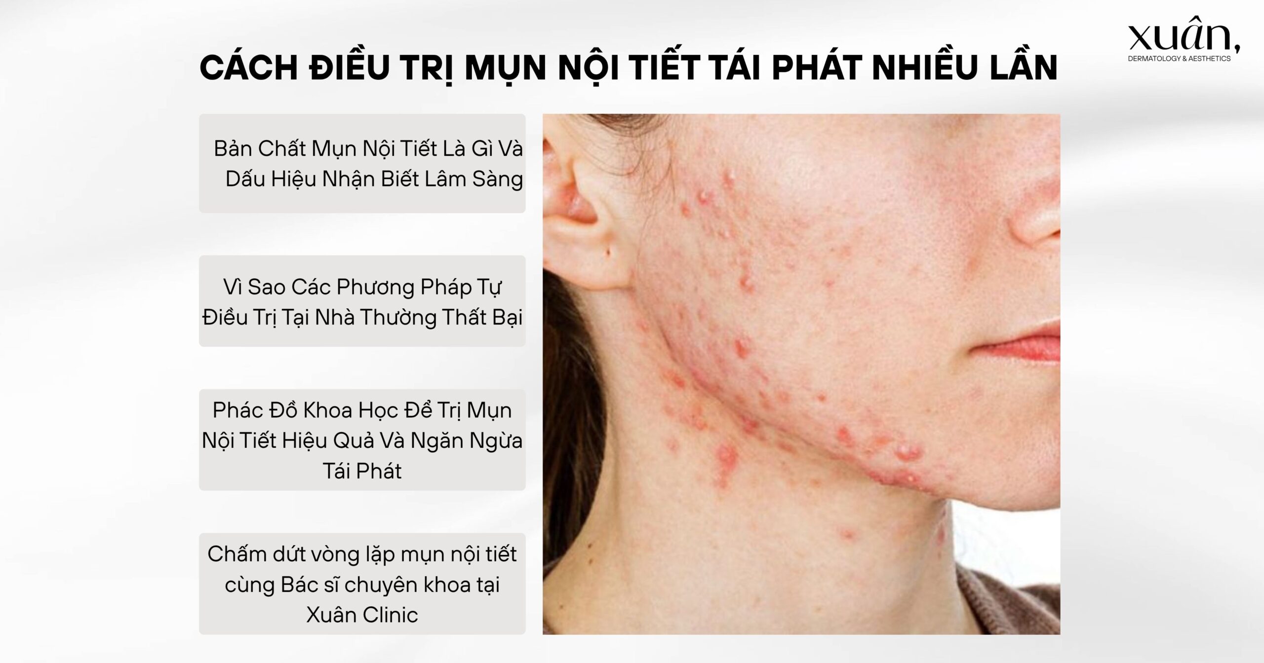 Cách Điều Trị Mụn Nội Tiết Tái Phát Nhiều Lần – Kinh Nghiệm Cho Người Bị Mụn