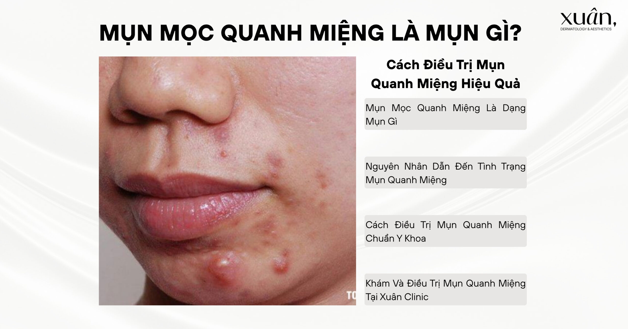 Mụn Mọc Quanh Miệng Là Mụn Gì? Cách Điều Trị Mụn Quanh Miệng Hiệu Quả
