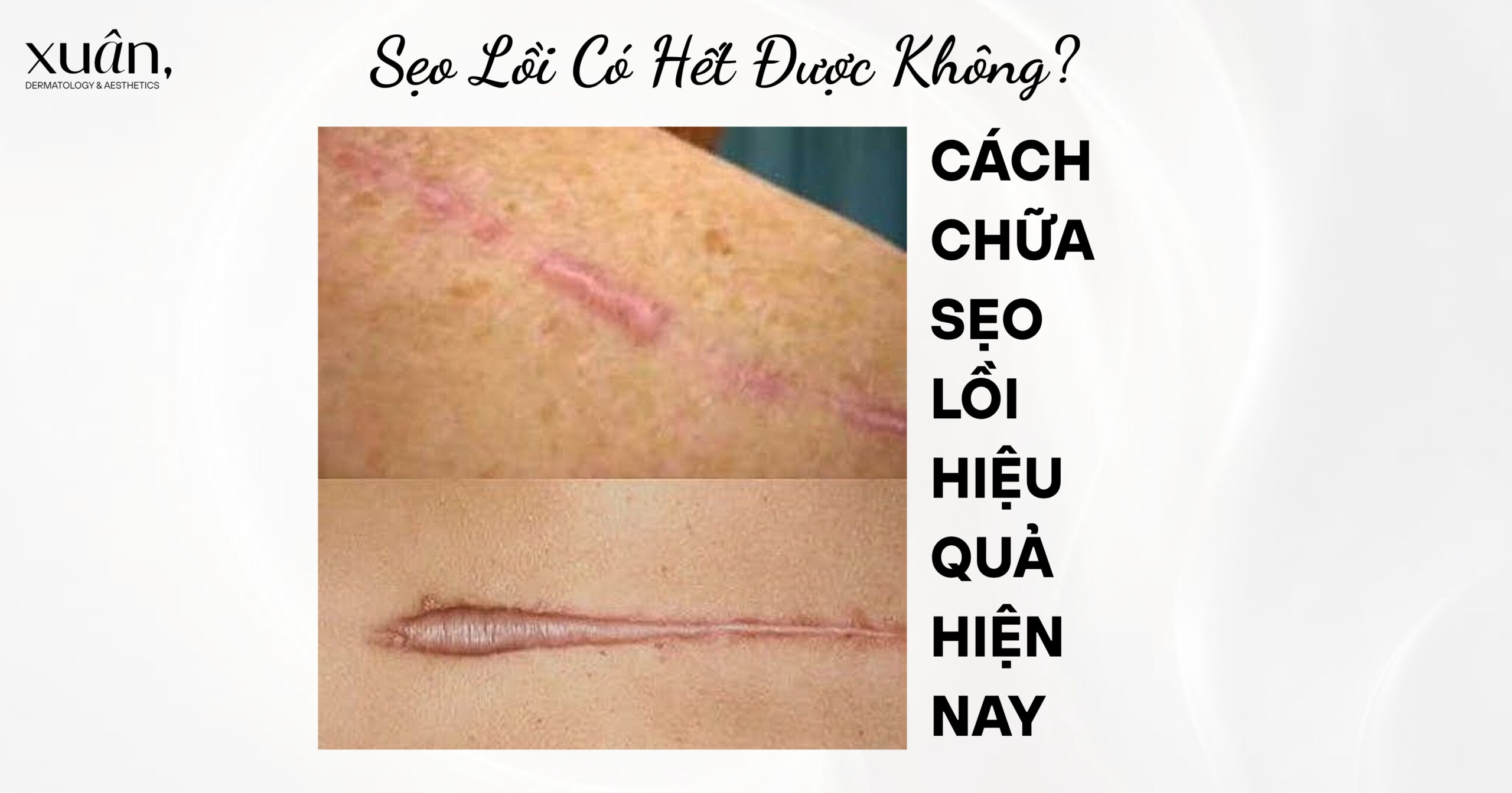 Sẹo Lồi Có Hết Được Không? Cách Chữa Sẹo Lồi Hiệu Quả Hiện Nay