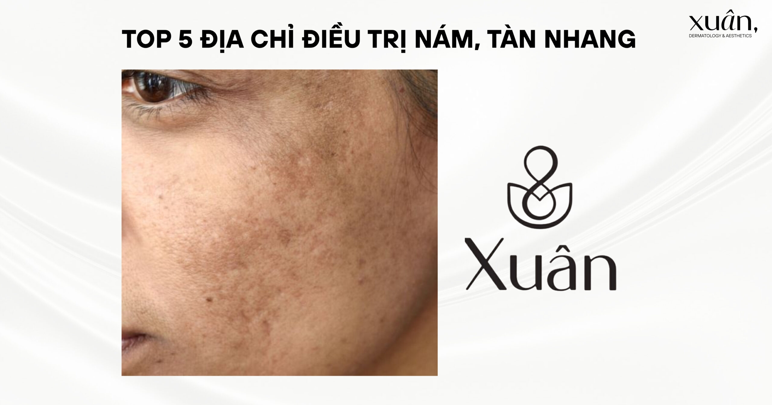 Top 5 Địa Chỉ Điều Trị Nám, Tàn Nhang Ở Hà Nội Được Nhiều Người Tin Tưởng Lựa Chọn
