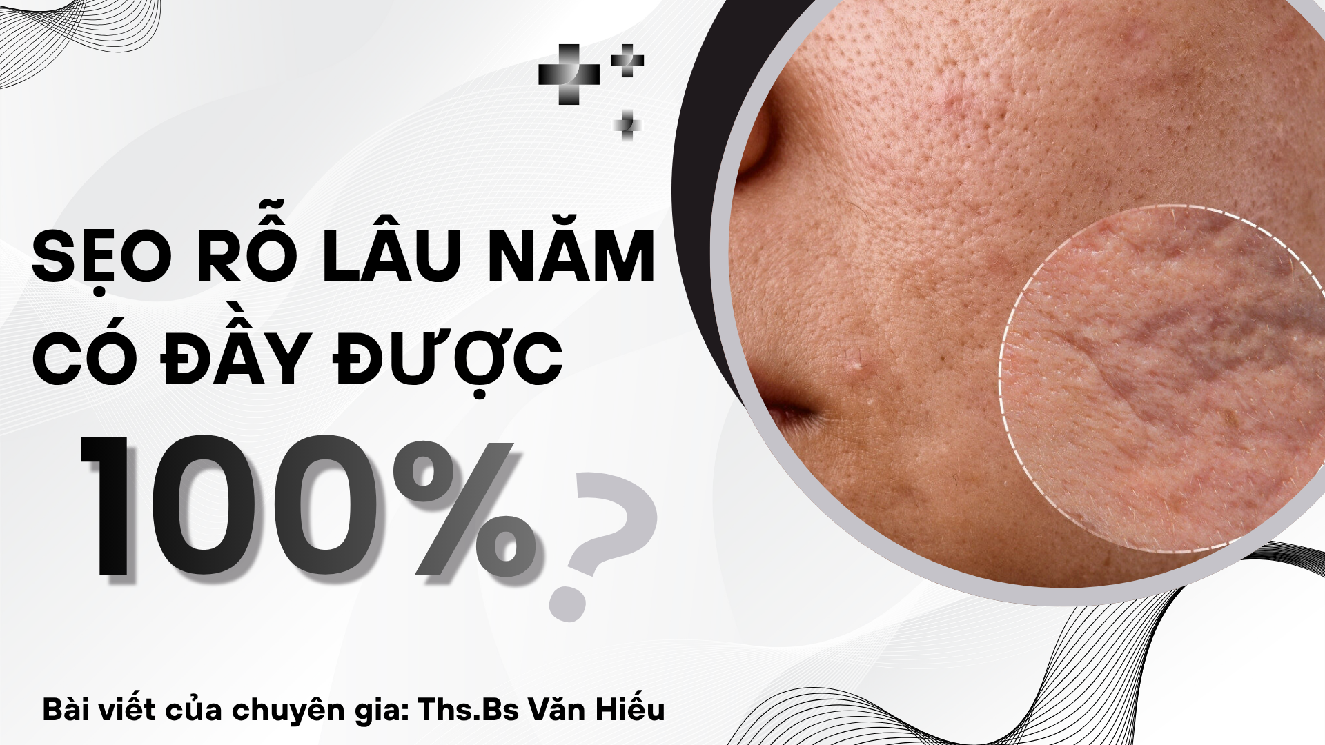 Sẹo Rỗ Lâu Năm Có Đầy Được 100% Không? Sự Thật Về Tỷ Lệ Phục Hồi